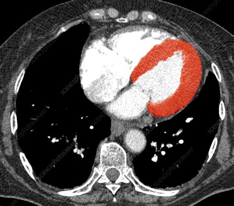 lv ct|left ventricular enlargement ct.